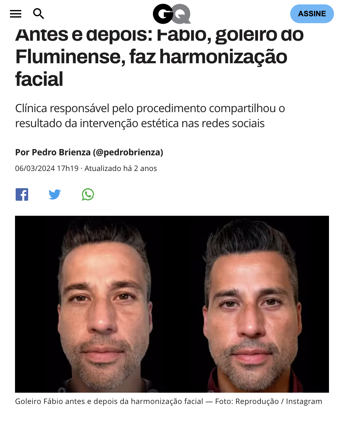 Matéria Globo sobre harmonização facial do goleiro Fábio