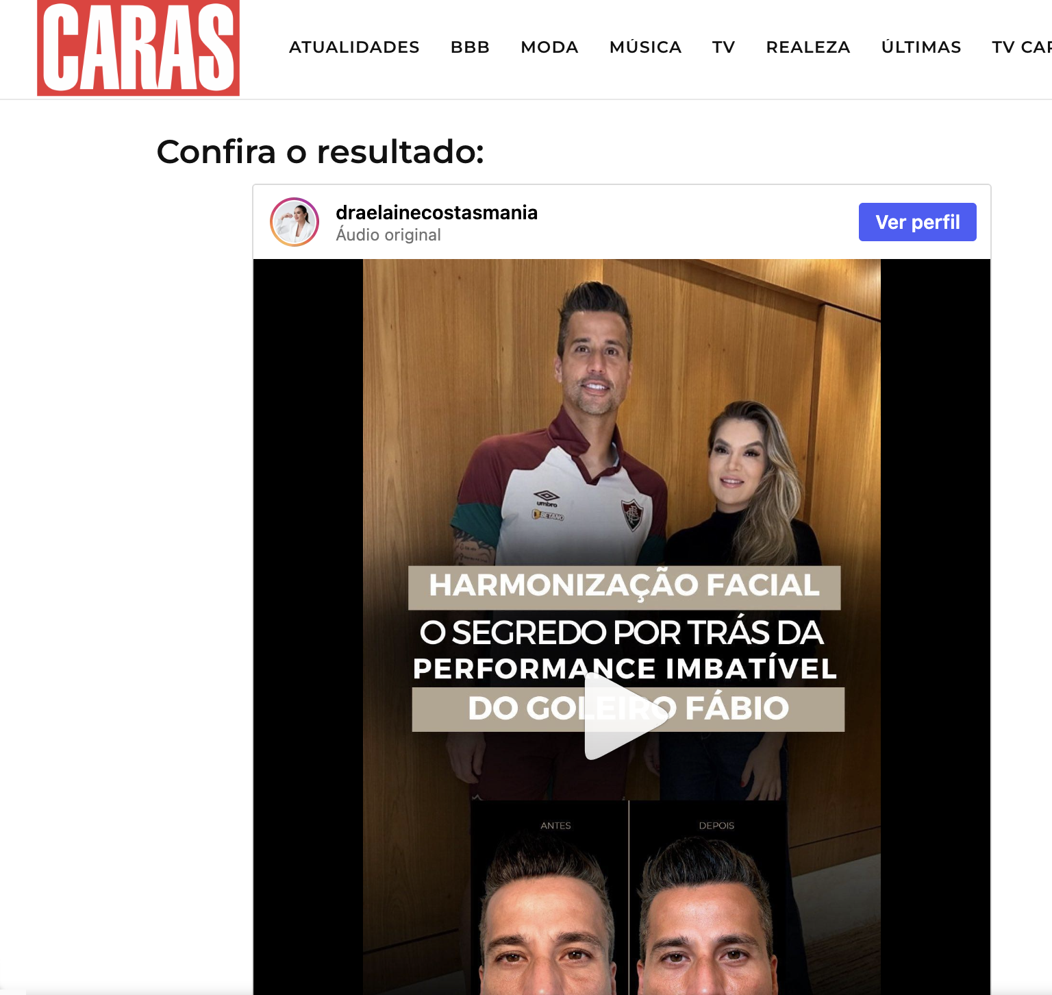 Matéria Caras sobre harmonização facial do goleiro Fábio