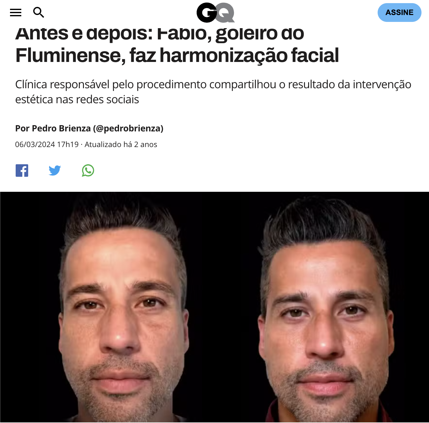 Matéria Globo sobre harmonização facial do goleiro Fábio